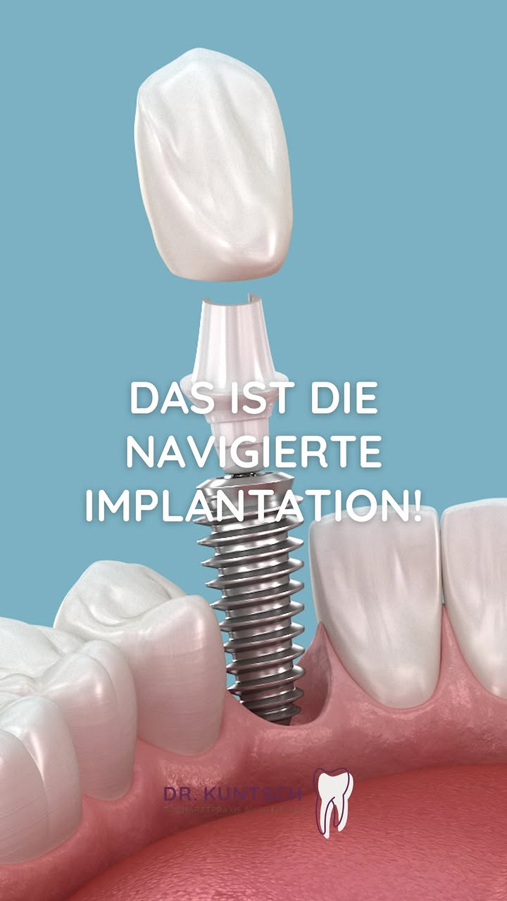 Das musst du über die navigierte Implantation wissen! 🦷
 #zahnarzt #zahnarztkempten #praxis #zahngesundheit #kempten #za…
